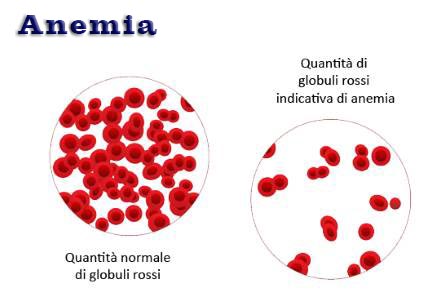 Esempio di quantità di globuli rossi in un campione di sangue di un soggetto normale e uno con anemia. Nel secondo ci sono meno globuli rossi