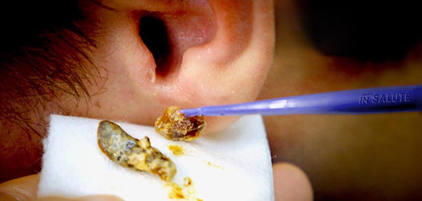 Medico estrae del cerume dell'orecchio con apposito strumento medico