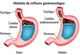 Sezione dello stomaco con esempio di reflusso gastroesofageo