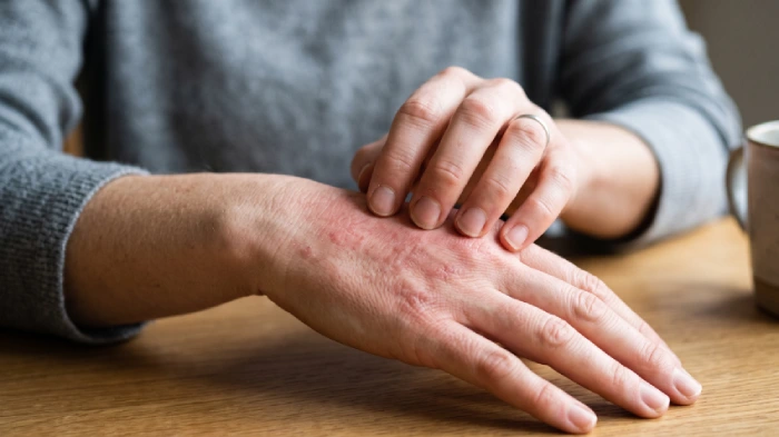 Donna, intollerante al nichel, si gratta il dorso di una mano arrossato