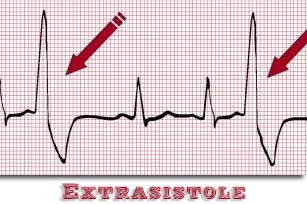 Elettrocardiogramma con evidenziate delle extrasistole