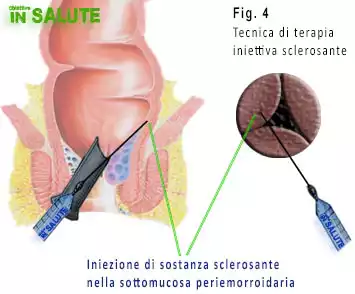 Esempio di terapia iniettiva