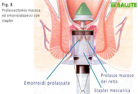 Prolassectomia mucosa