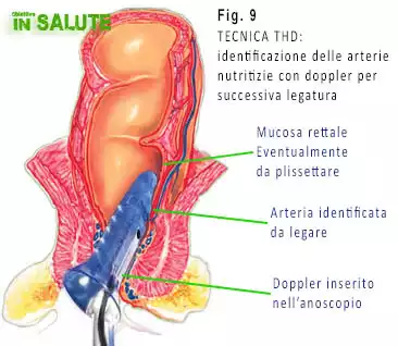 Esempio di tecnica THD