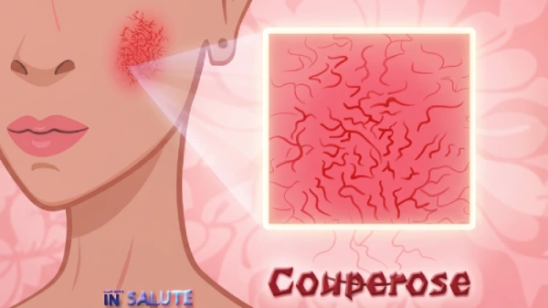 Illustrazione che proietta in primo piano il dettaglio di couperose in una givane donna