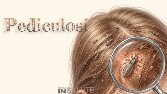 Pidocchi sul cuoio capelluto con ingrandimento di un pidocchio