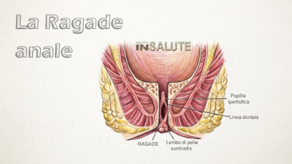 Sezione dell'ano con indicazione della ragade