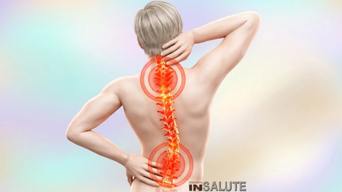 Immagine stilizzata di un uomo con evidenziate le curve della colonna vertebrale affetta da scoliosi