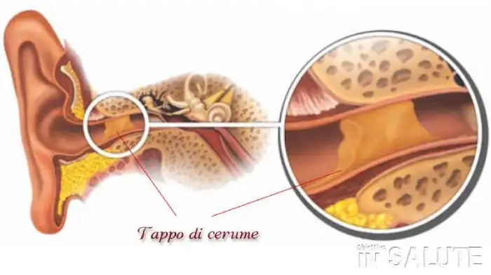 Sezione dell'orecchio con presente un tappo di cerume