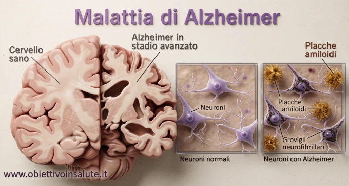 immagine in cui vengono affiancati due porzioni di cervello, una parte sana e l'altra con l'alzheimer. La seconda appare più atrofizzata e con delle placche amiloidi