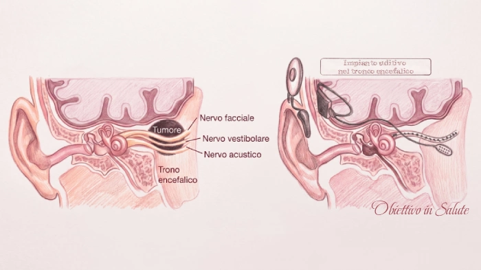 Immagine che mostra una doppia sezione del cervello e delle orecchie. Nella prima viene raffigurato il tumore asportato, nella seconda viene mostrato come è stato posizionato l'impianto descritto nell'articolo