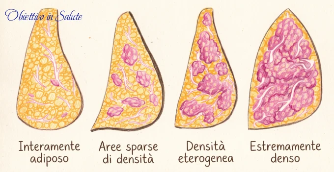 Immagine che rappresenta graficamente la differenza tra le diverse tipologie di seno che vanno dal seno interamente adiposo al seno estremamente denso